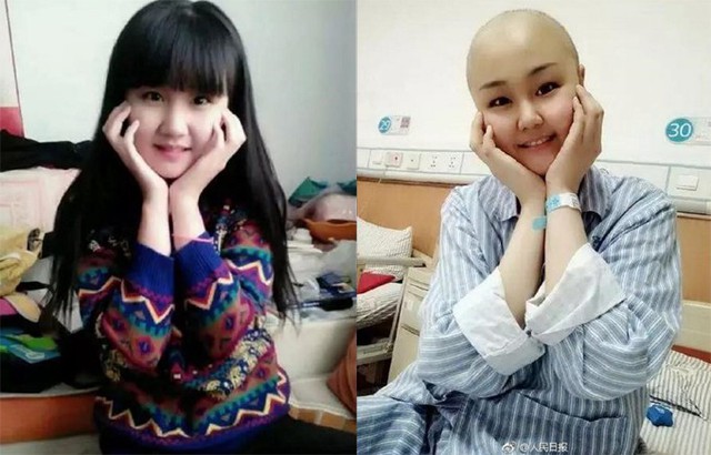 Sun Ying trước và sau khi hóa trị.