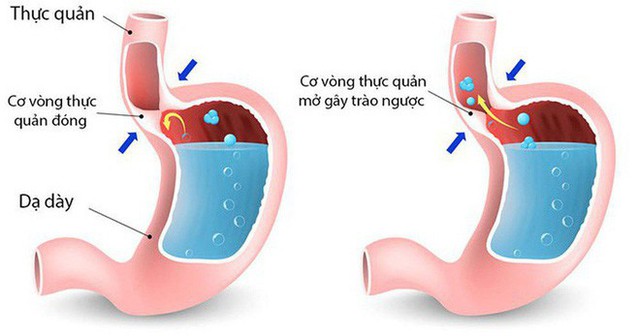 Nếu có 1 trong 4 dấu hiệu sớm nhất của bệnh ung thư dạ dày, tuyệt đối không nên xem nhẹ - Ảnh 4.