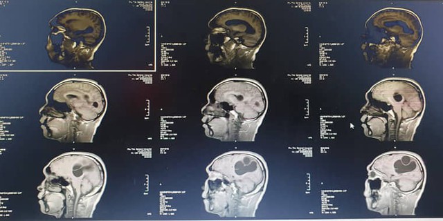 
Hình ảnh CT, MRI sọ não, kén sán não trước khi phẫu thuật. Ảnh: TL
