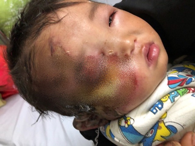  Phần mặt của bé Kê, mắt phải bị ảnh hưởng nặng sau tai nạn 