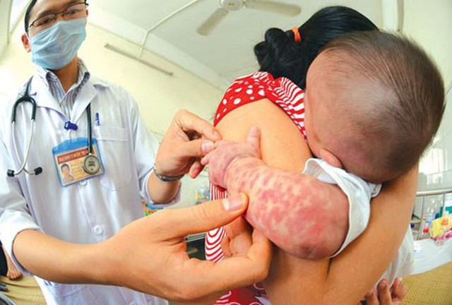 Ban sởi mọc theo thứ tự bắt đầu ngày thứ nhất từ đầu, mặt, cổ. Ngày thứ 2 mọc ở ngực lưng, cánh tay. Ngày thứ 3 mọc ở bụng, mông, đùi, chân. Khi ban mọc tới chân hết sốt và ban bắt đầu bay. Khi bay sẽ để lại những vết thâm trên da rất đặc trưng thường gọi là “vằn da hổ”. Ảnh: Internet.