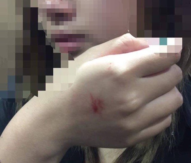 Vết thương để lại trên thân thể cô gái sau vụ cưỡng hôn trong thang máy. Ảnh: NVCC.