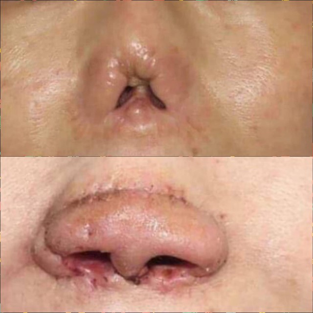 
Hình ảnh trước và sau khi được tái tạo mũi của bệnh nhân.

