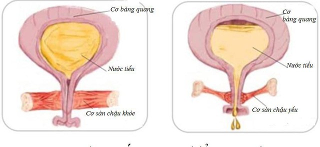 Tiểu són, tiểu nhiều lần, hội chứng bàng quang kích thích do cơ bàng quang, cơ sàn chậu yếu