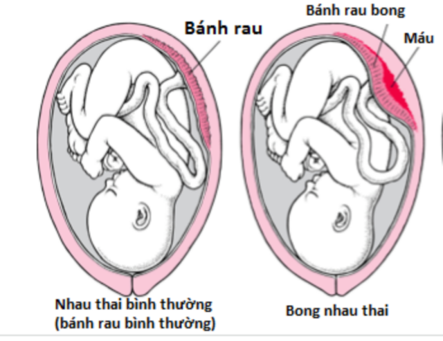 
Bé trai mạnh mẽ cất tiếng khóc chào đời dù bánh nhau đã bỏng hơn nửa. Ảnh minh họa
