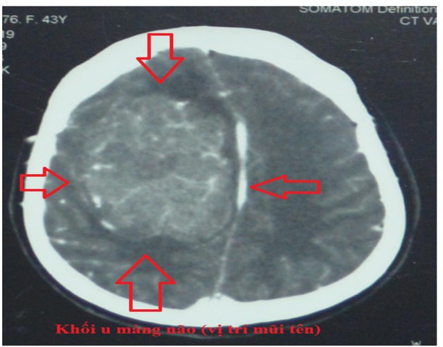 
Khối u trong não bệnh nhân qua hình ảnh CTScan. Ảnh BVCC
