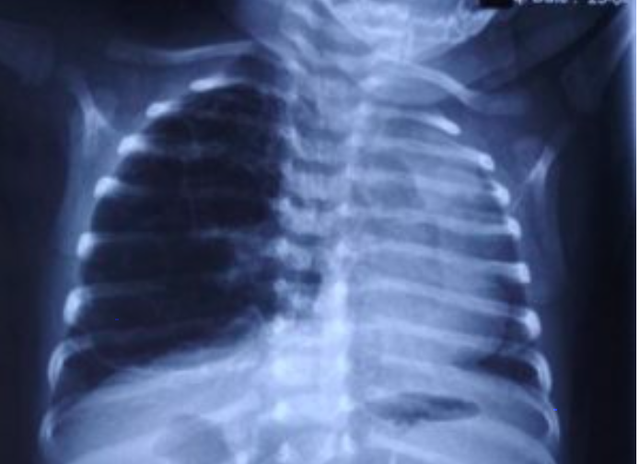 Hình ảnh X quang thường cho thấy dị dạng nang tuyến phổi phải đè đẩy khí quản và tim sang đối diện