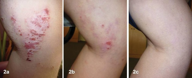 Hình ảnh trước và sau 8 tuần điều trị bằng sản phẩm Dr Michaels Dermatinex
