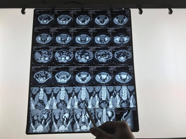 
Hình ảnh khối sọi niệu quản kích thước lớn của bệnh nhân C.T.N. Ảnh: BVCC
