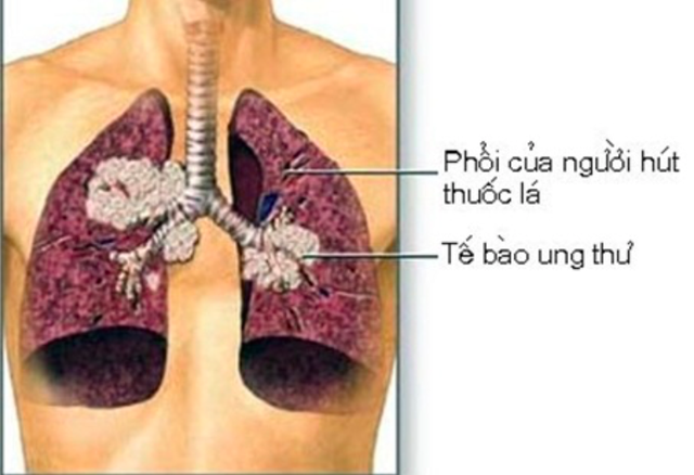
Hút thuốc lá là nguyên nhân chính gây ung thư phổi
