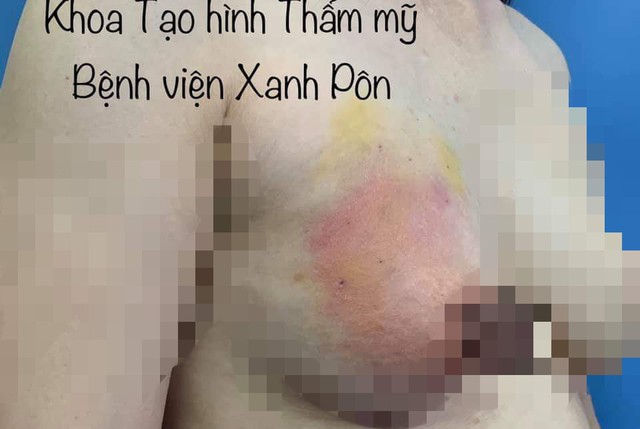 Ngực bệnh nhân bị sưng, viêm tấy đỏ sau khi được thực hiện phương pháp thông cơ tại spa. Ảnh: BSCC