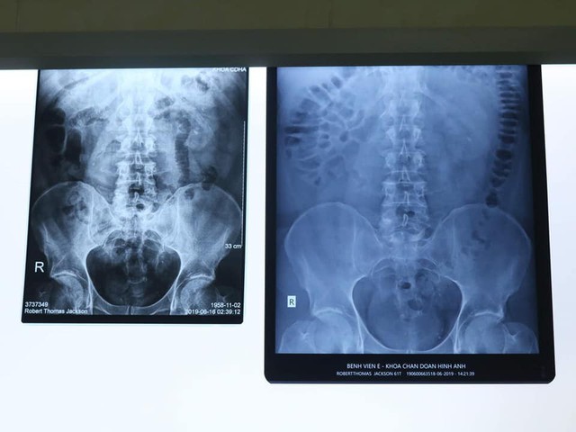 
Hình ảnh chụp X-quang cho thấy, bệnh nhân bị sỏi niệu quản. Ảnh: BVCC
