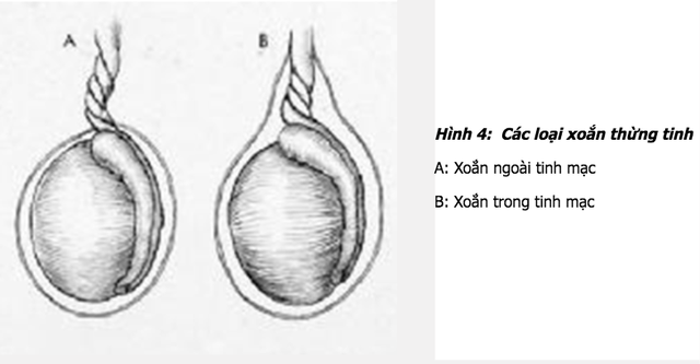 
Các loại xoắn thừng tinh
