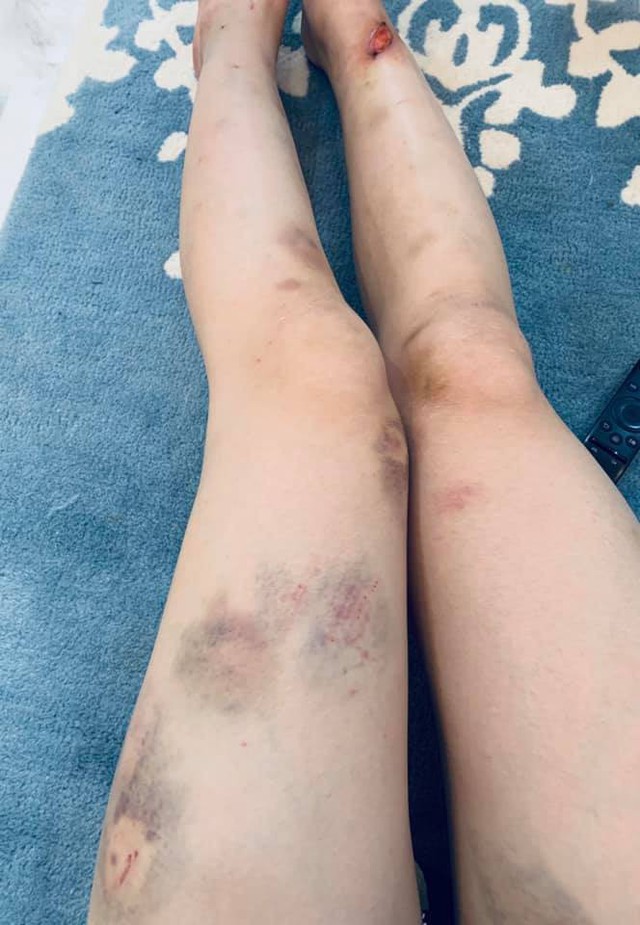 
Hình ảnh đôi chân bầm dập, bị chấn thương của Phương Oanh
