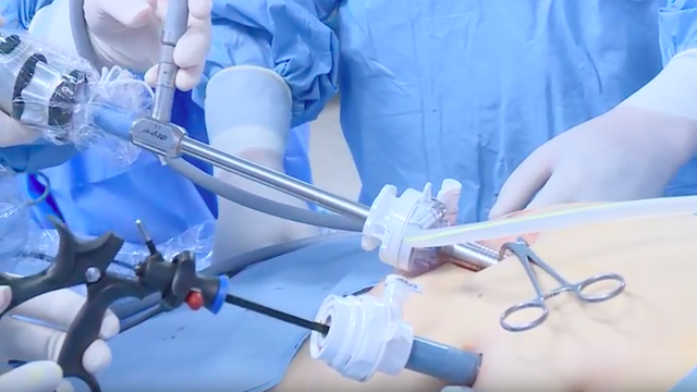 
Phẫu thuật nội soi thu nhỏ dạ dày hình ống nhằm loại bỏ hoàn toàn vùng phình vị lớn
