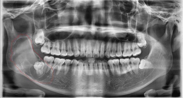 Hình ảnh cho thấy khối nang lạ góc hàm phải bệnh nhân (khoanh đỏ)