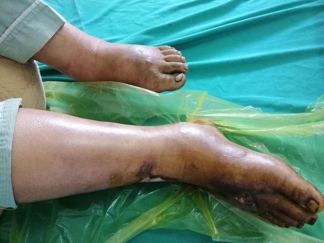 
Bệnh nhân Hờ A Trừ đang cấp cứu do nhiễm khuẩn huyết, do 2 tháng trước bị phù, loét bàn chân phải, chảy nhiều dịch vàng. Ảnh: BV đa khoa Điện Biên.
