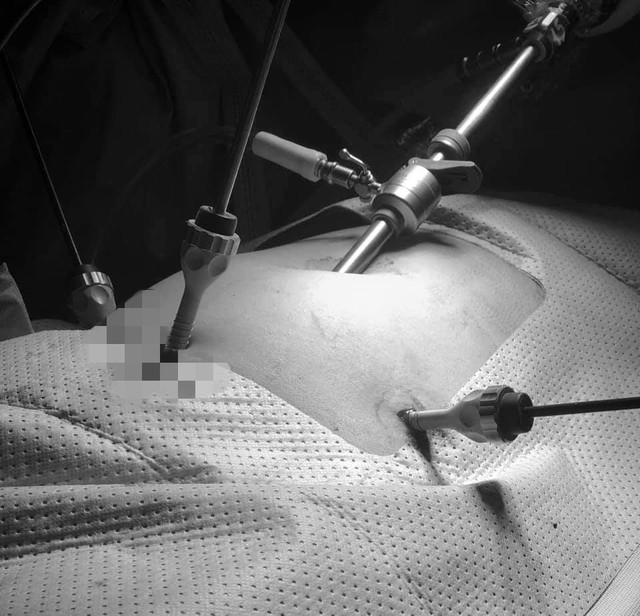 
Các bác sĩ tiến hành phẫu thuật nội soi cắt tử cung cho bệnh nhân. Ảnh BVCC
