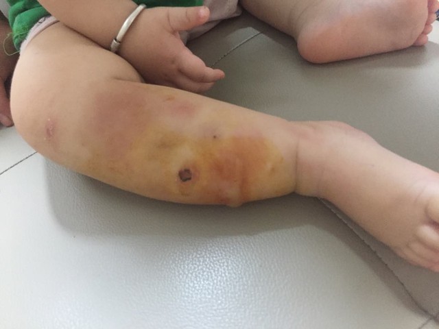 
Cẳng chân em bé 1 tuổi bị sưng nề, nóng đỏ, nhiều mụn mủ nhỏ màu vàng chỉ vì một nốt mụn nhỏ
