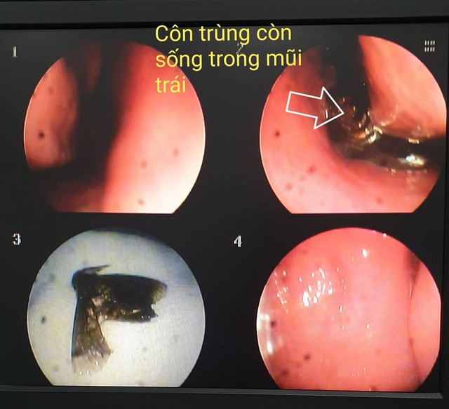 
Hình ảnh nội soi cho thấy côn trùng còn sống trong mũi trái nữ bệnh nhân
