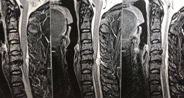 
Hình ảnh trên phim chụp cộng hưởng từ cho thấy khối máu tụ rất lớn, chèn ép ống tuỷ cổ, nguyên nhân gây liệt cho bệnh nhân. Ảnh: BSCC
