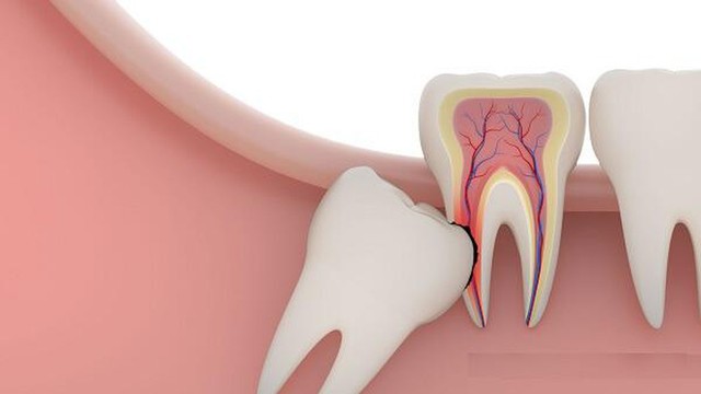 Mất mạng vì nhổ răng, chuyên gia cảnh báo 4 thời điểm tuyệt đối không nhổ răng khôn - Ảnh 3.