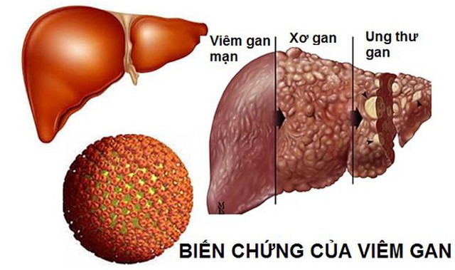 25.000 người chết vì ung thư gan mỗi năm, cách nào phát hiện sớm? - Ảnh 1.