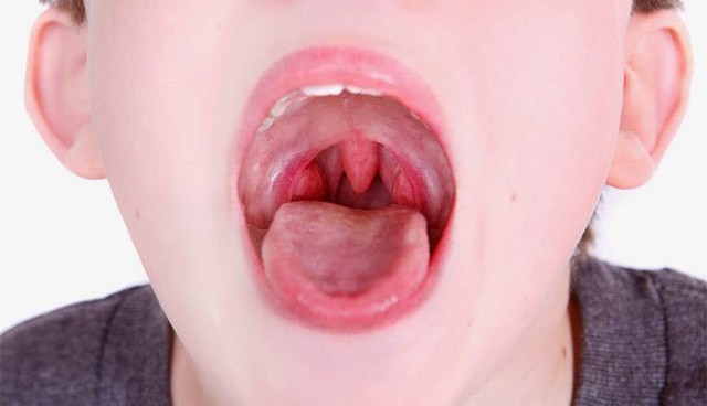 10 nguyên nhân khiến cổ họng có cảm giác bị vướng  - Ảnh 3.