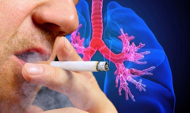U phổi – Căn bệnh có xu hướng ngày càng tăng nhanh trên toàn cầu - Ảnh 2.
