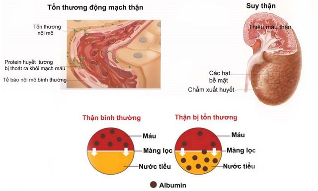 Người già bị cao huyết áp có thể suy thận bất cứ lúc nào - Ảnh 1.