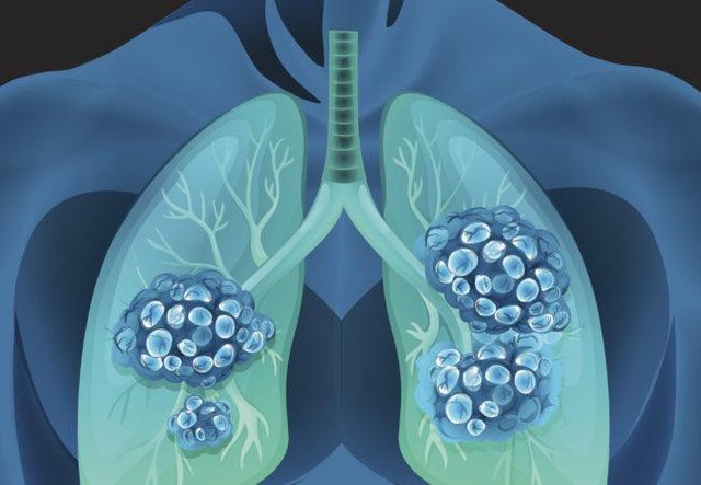 Sản phẩm Tumolung – Bước đột phá mới trong việc phòng ngừa và hỗ trợ điều trị u phổi - Ảnh 2.