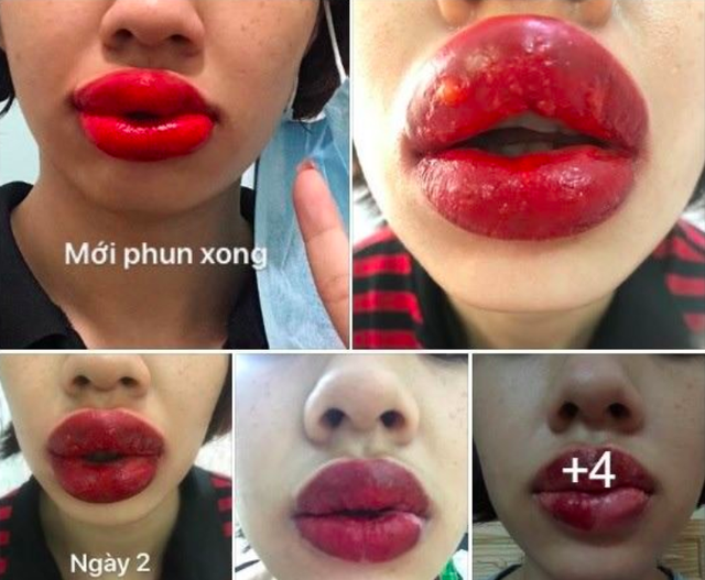 Cô gái ở Hà Nội bị sưng tều môi, nổi mụn nước sau khi làm ở spa gần nhà - Ảnh 2.