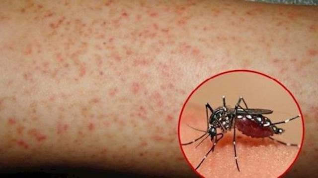 Từ vụ nữ tiếp viên mất mạng do muỗi đốt, chuyên gia cảnh báo dấu hiệu nguy hiểm không thể bỏ qua - Ảnh 3.