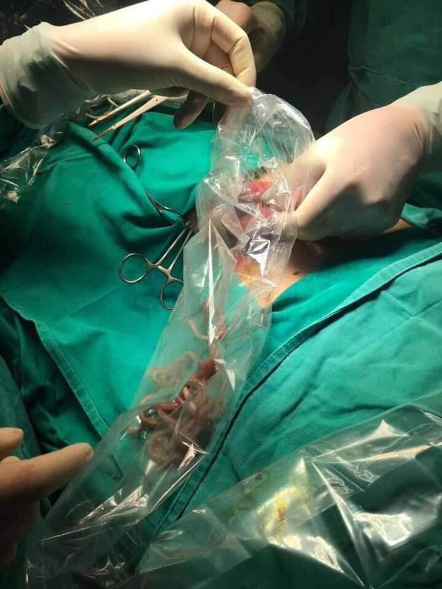Từ vụ mổ cấp cứu lấy búi giun 100 con trong bụng bệnh nhân 11 tuổi, cha mẹ cần làm ngay những việc này kẻo sau lại hối tiếc - Ảnh 3.