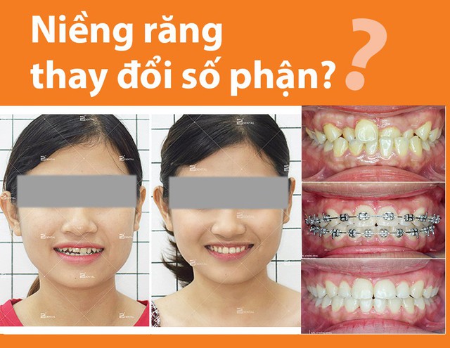 Kinh nghiệm niềng răng thay đổi số phận dành cho chị em - Ảnh 1.