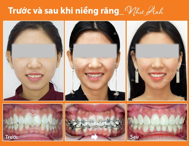 Kinh nghiệm niềng răng thay đổi số phận dành cho chị em - Ảnh 4.