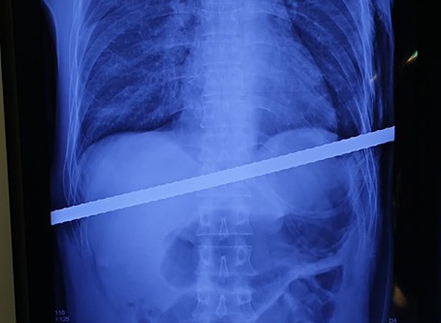 Hình ảnh cho thấy thanh sắt đâm xuyên qua gan, phổi bệnh nhân