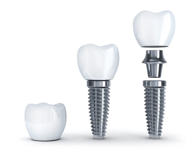 Nha khoa My Auris – Địa chỉ trồng răng Implant uy tín và an toàn - Ảnh 2.