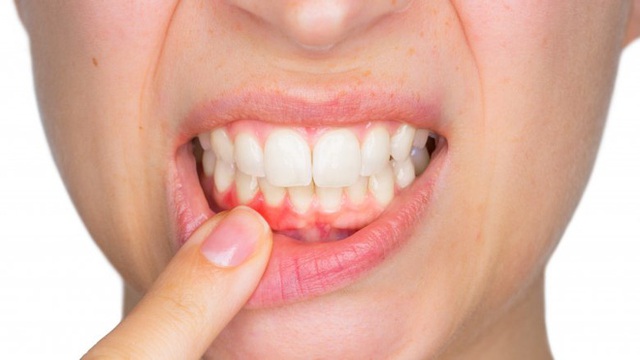  Những căn bệnh từ việc không đánh răng hàng ngày - Ảnh 3.