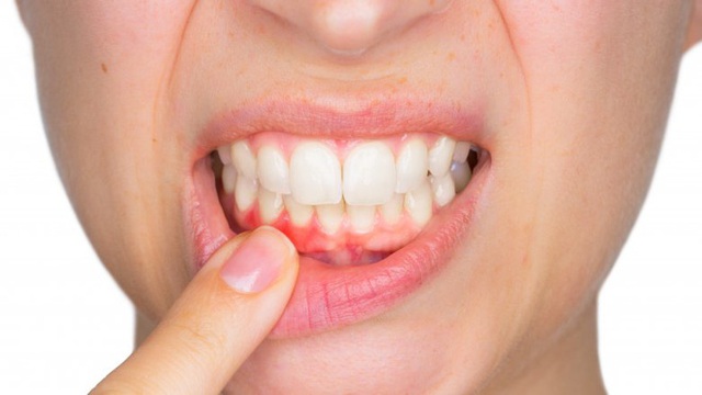 Những căn bệnh từ việc không đánh răng hàng ngày - Ảnh 3. Những căn bệnh từ việc không đánh răng hàng ngày - Ảnh 3.