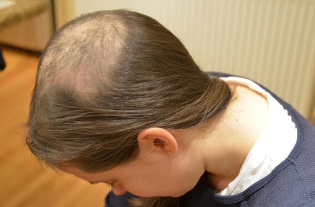 Con gái liên tục tự nhổ tóc mỗi ngày, 15 tuổi đã hói cả đầu, mẹ đưa đi khám mới tá hóa phát hiện sự thật - Ảnh 3.