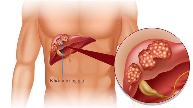 20 tuổi đột ngột phát hiện ung thư gan chỉ qua biểu hiện nhỏ - Ảnh 1.