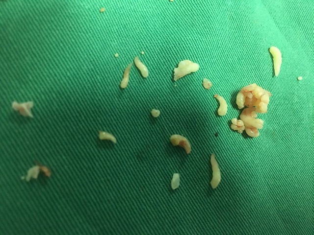 Bác sĩ lấy ra gần 20 chiếc răng trong khối u - Ảnh 1.