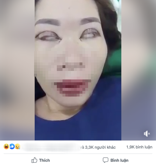 Đôi mắt gây ám ảnh bậc nhất hôm nay là trường hợp cắt mí lỗi đến mức không thể khép mắt này: BS khuyến cáo những thông tin cần nhớ trước khi làm - Ảnh 3. Đôi mắt gây ám ảnh bậc nhất hôm nay là trường hợp cắt mí lỗi đến mức không thể khép mắt này: BS khuyến cáo những thông tin cần nhớ trước khi làm - Ảnh 3.