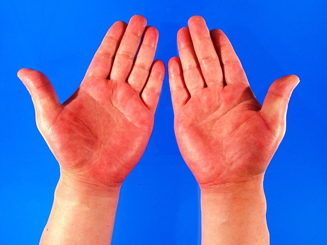 Quan sát đôi tay, nếu thấy có 3 tín hiệu xấu thì nên chú ý sức khỏe vì nguy cơ mắc bệnh về gan rất cao - Ảnh 4.