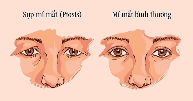 Điều trị sụp mí bằng Đông y – trẻ hóa cơ mắt, cải thiện tầm nhìn - Ảnh 1.