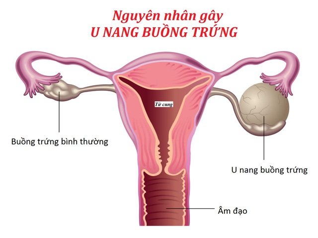 Tại sao hàng ngàn người lựa chọn Nga Phụ Khang để cải thiện u nang buồng trứng trong 15 năm qua? - Ảnh 1.