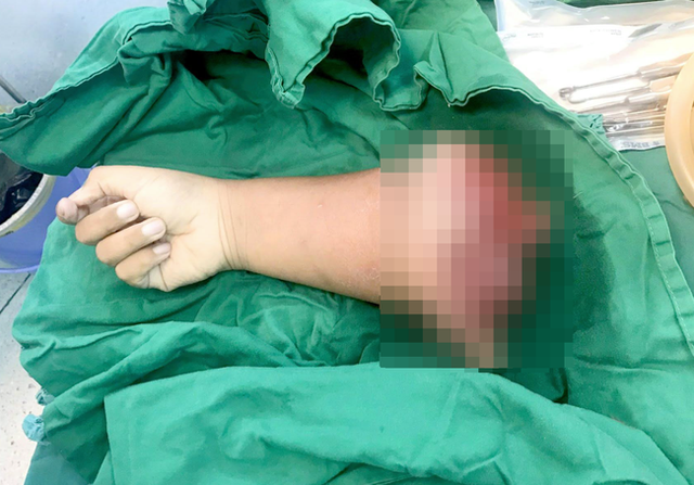 Kinh hoàng: Bé trai 8 tuổi tự chạy xe máy gặp tai nạn đứt lìa cánh tay - Ảnh 1.