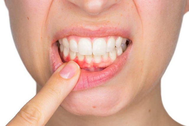 Cảnh báo: Những người bị chảy máu nướu răng có nguy cơ đột quỵ não cao gấp 2 lần người bình thường - Ảnh 1.