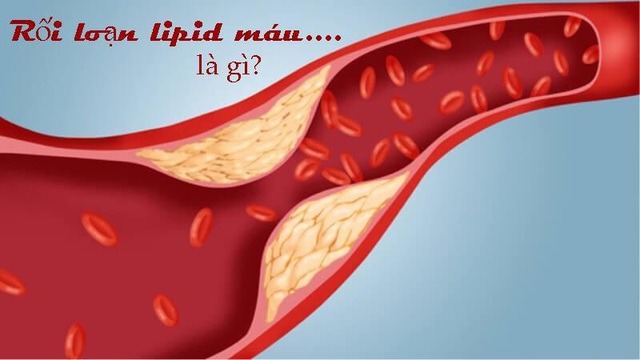 Lipidcleanz - “Vũ khí” loại bỏ rối loạn lipid máu! - Ảnh 1.